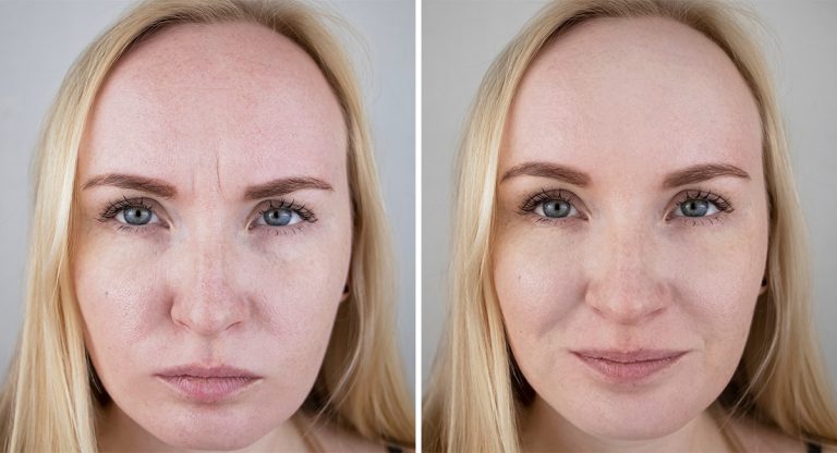 Botox for Frown Lines (11s) procedure