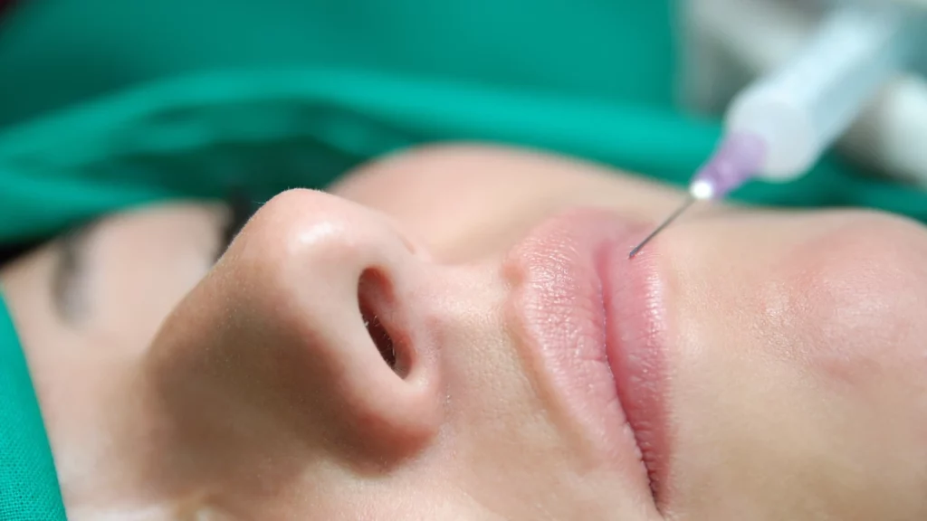 Lip Flip Treatment procedure